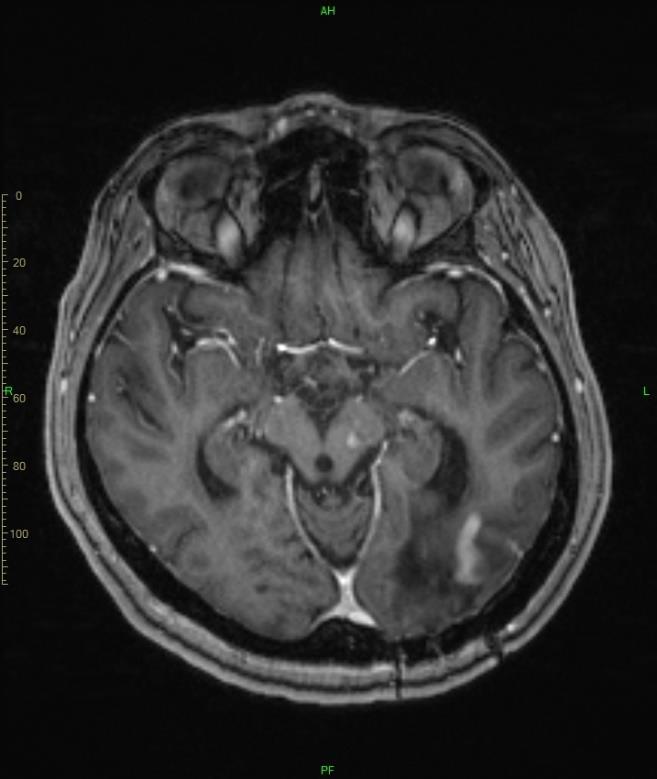 subcorticalis fehérállományt és helyenként a leptomeninxeket is érintik - liquor öfeh: 1.