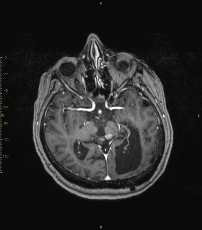 2011 azathioprin mellett steroid lassú leépítése, elhagyása - látászavar és aphasia fokozódása, rövidtávú memória romlása, focalis epilepsiás rosszullét - cyclophosphamid kezelés indul, kb.