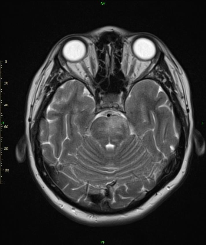 szövetből és bo-i temporalis meninxből biopsia - sarcoidosis - mellkas