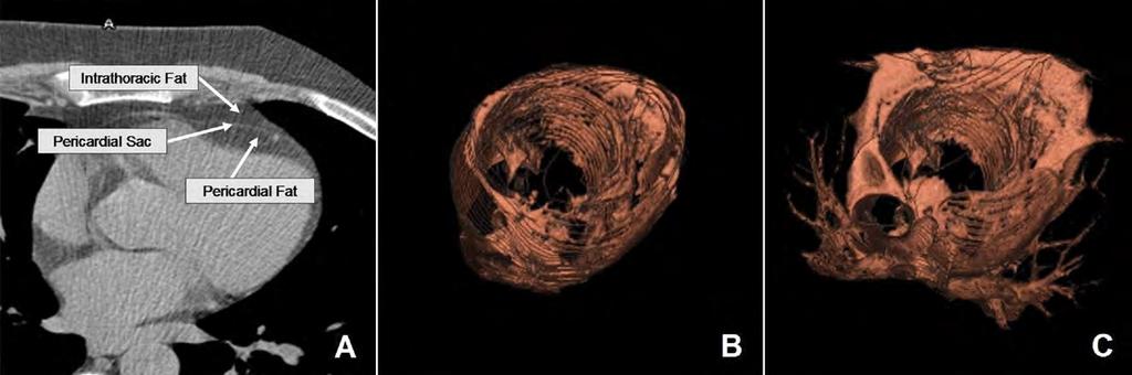 A perikardialis és mellüregi zsírszövet CT kvantifikációja A perikardialis és mellüregi zsírszövet axialis CT képe (A), a
