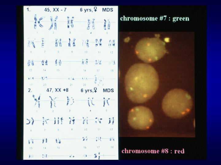1.1. 1.1.1. ábra Két különböző időpontban elvégzett metafázis citogenetikai vizsgálat 7-es monosomiát és 8-as disomiát (1) illetve 7-es disomiát és 8-as trisomiát (2) mutatott.