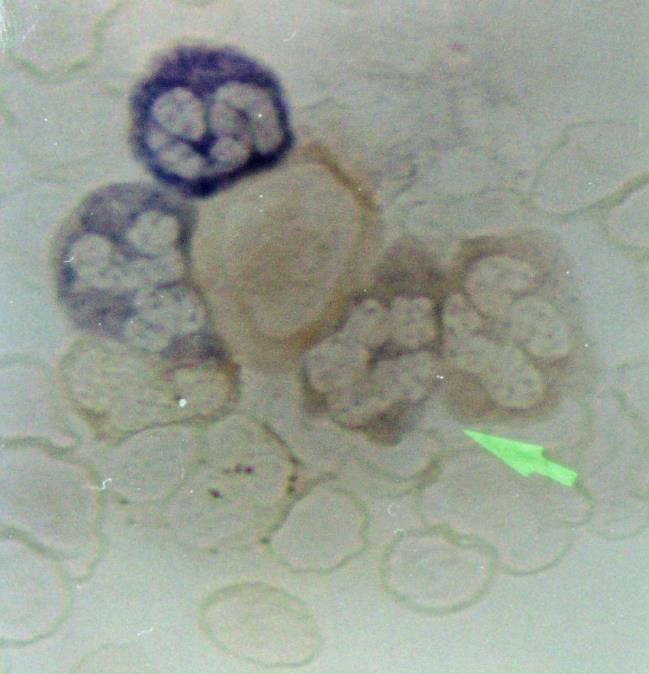 suppressziója mellett domináló granulo- és megakaryopoesis látható (b); perifériás vérsejtek alkalikus