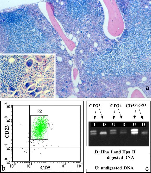 és x 200 (inszert); b a flow citometriás immunfenotipizálás a CD19+ fehérvérsejtek CD5 CD23 ko-expresszióját mutatja; c HUMARA teszt - a PCR termék elektroforetikus szeparálása, a flow szortírozott