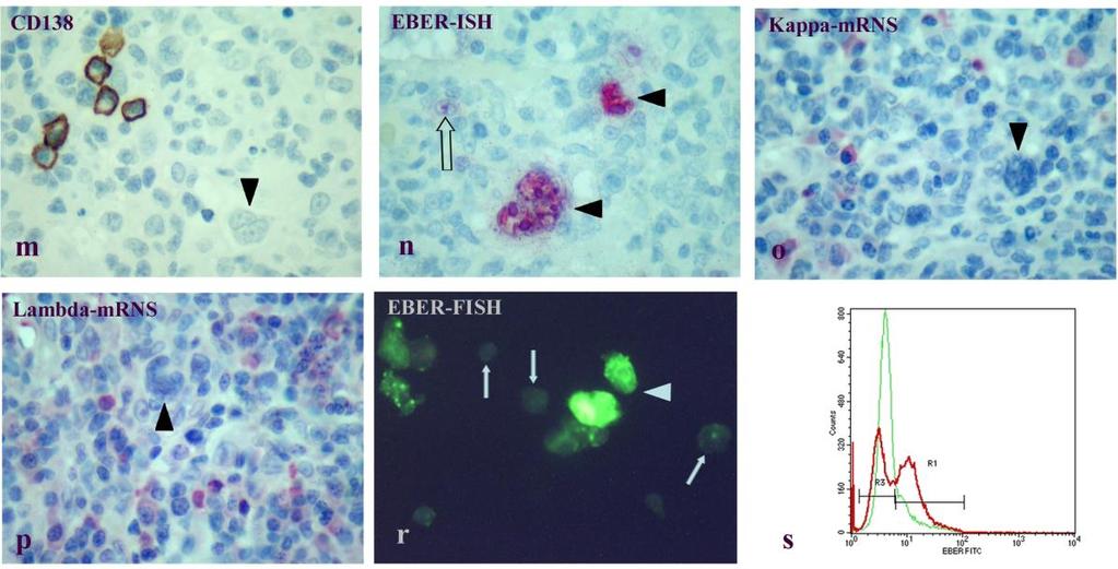 nem mutatható ki a HRS-szerű sejtekben, de a reaktív plasmasejtek pozitívan jelölődnek.
