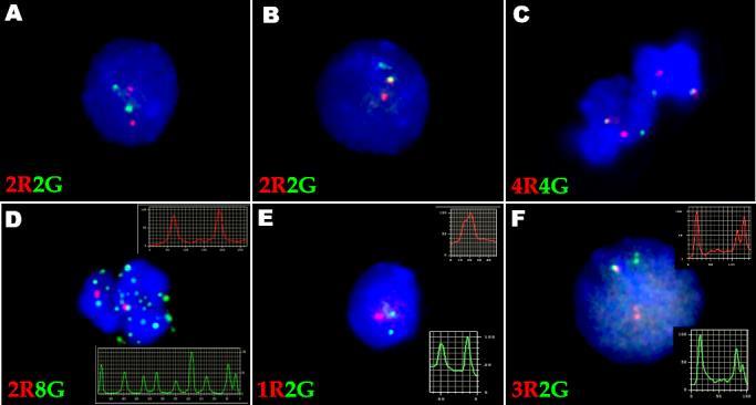 3.5 3.5.1. ábra Normál és a szignál felismerés hibája miatti - abnormális szignál mintázatok t(9;22)(q34;q11) specifikus egyszeri fúziós próvával történt ifish jelölés során.