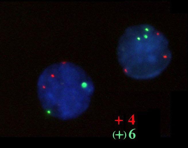 1.2. a b 1.2.2.a-b. ábra: Hiperdiploid (DNS index: 1,28) gyemekkori common acut lymphoblastos leukaemia.