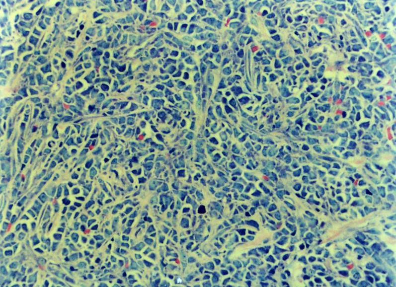 1.2. 1.3.2.c ábra: Subcutan, anaplasiás, kloroacetát észteráz, lysosym, CD15, CD68, peroxidase, T- és B-, epiteliális, neurogén, myeloid és myogen markerekre negatív tumor fénymikroszkópos képe