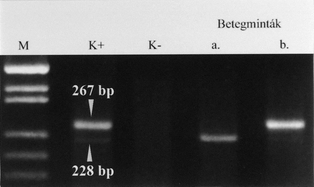 3.2 monitorizálására a sejtalapú SFM/KIIF analizist kombináltuk különböző DNS markerek valamint az RNS expresszió valósidejű, klón specifikus, kvantitativ polimeráz láncreakció (RQ-PCR, RQ-RT-PCR)