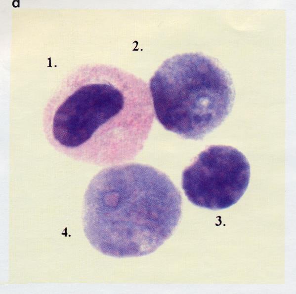 Csak a lymphoblastok tartalmaznak bcr-abl átrendeződésre utaló sárga fúziós jelet, fluoreszcens mikroszkópos üzemmód, x 1250