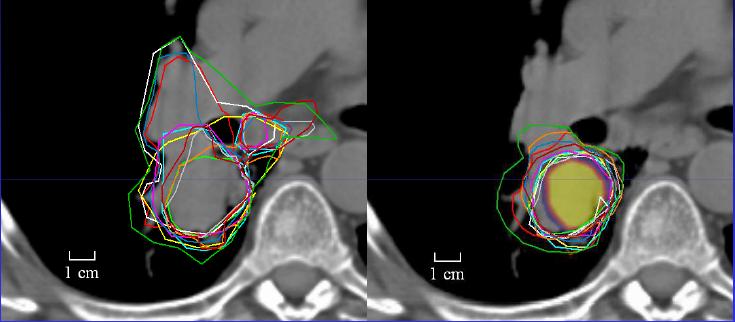Pontatlan, illetve feleslegesen nagy kontúrok használata felesleges ép területek besugarazását vonja után, ami nem csak a védend szervek dózisát növeli, de szerepe lehet egy esetleges kés bbi,