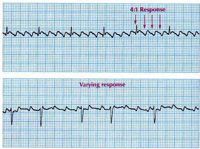 Atrial macroreentry (flutter) Folyamatos pitvari elektromos aktivitás