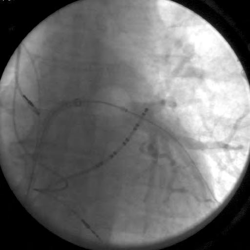 Standard transseptal puncture, Heparin to ACT