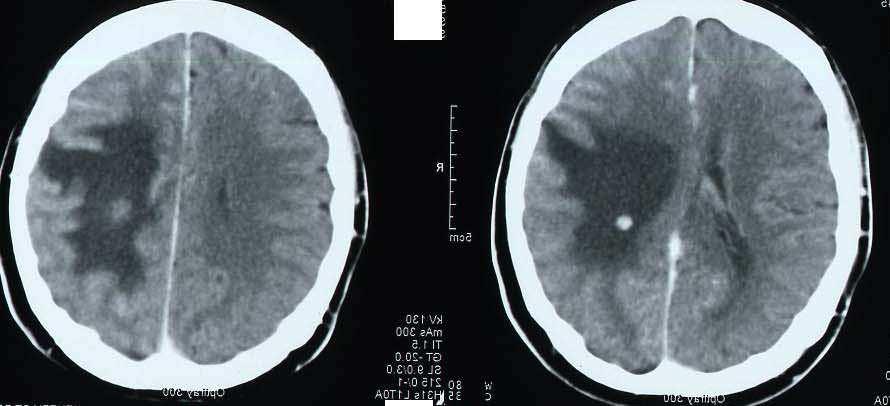 1. ábra. Pulmonalis adenokarcinoma metasztázis CT (fent) és glioblastoma multiforme (lent) MRI képe. A primer agydaganatok az intrakraniális daganatok második leggyakoribb csoportját jelentik.