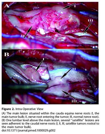 Human fetal neural stem cells- brain tumor N. Amariglio 2009: Donor-derived brain tumor following neural stem cell transplantation in an ataxia telangiectasia patient. PLoS Med.