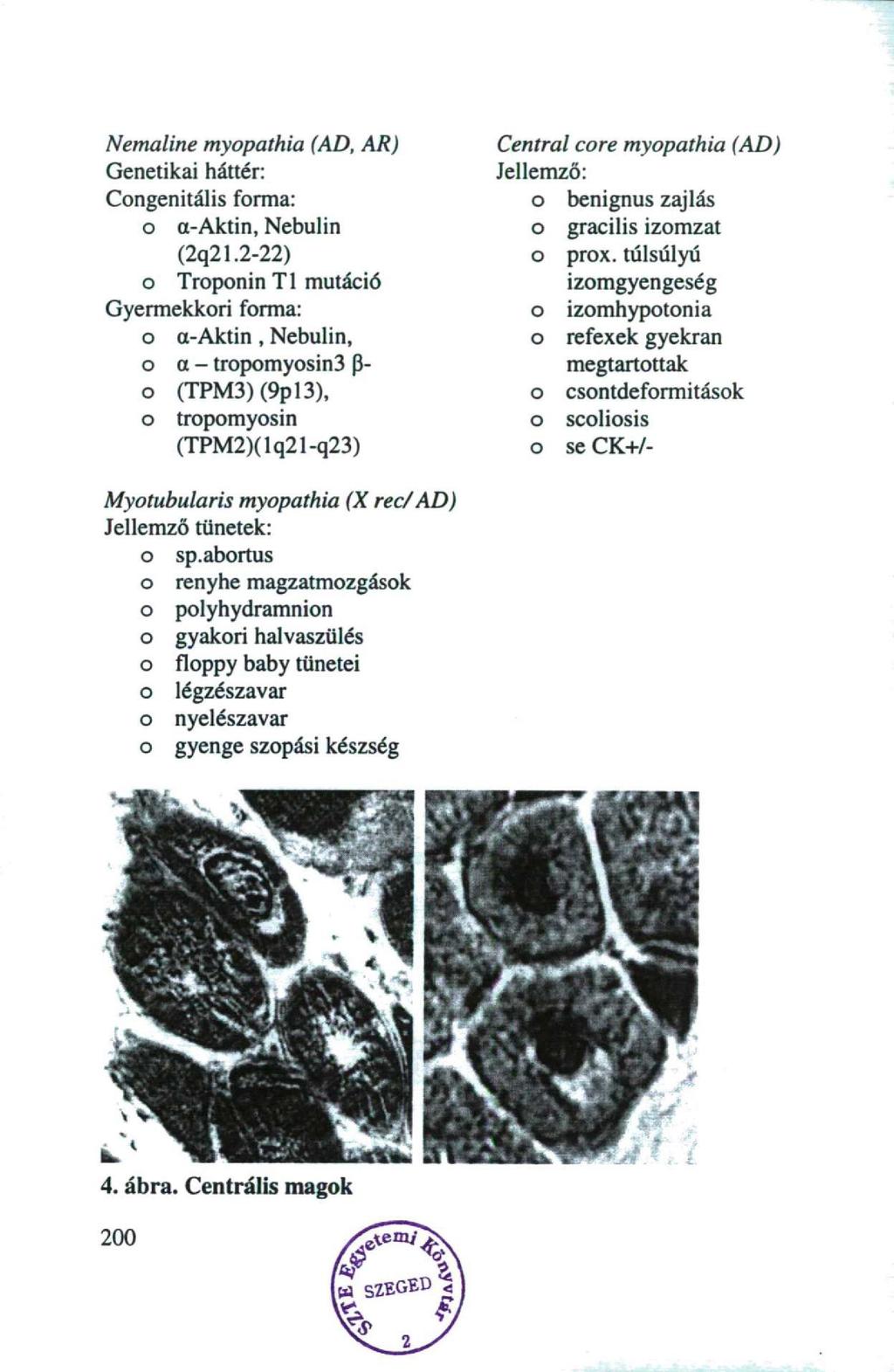 Nemaline mypathia (AD, AR) Genetikai háttér: Cngenitális frma: a-aktin, Nebulin (2q21.