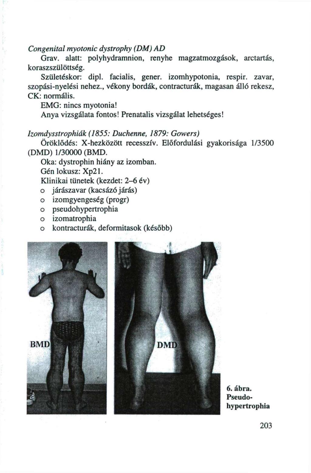 Cngenital mytnic dystrphy (DM) AD Grav. alatt: plyhydramnis renyhe magzatmzgásk, arctartás, kraszszülöttség. Születéskr: dipl. facialis, gener. izmhyptnia, respir. zavar, szpási-nyelési nehez.