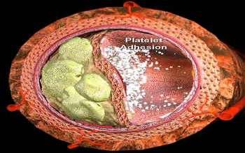 A MYOCARDIALIS ISCHAEMIA MEGJELENÉSI FORMÁI IV.