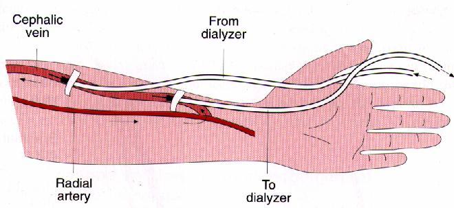 Vérnyerés Standard arteriovenous (AV) fisztula modified