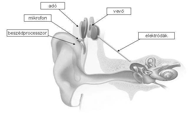 hallóideghez. Cochleáris implantátum szervezeten kívüli és szervezeten belüli, beültetett, implantált részekbõl áll. (1. sz. ábra) 1.