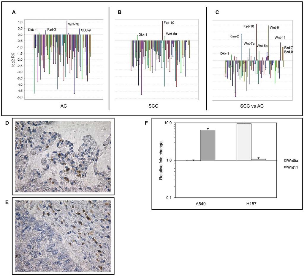 Wnt Signalling in Squamous Cell Lung Carcinoma Figure 1. Level of Wnt signalling molecules in AC and SCC.