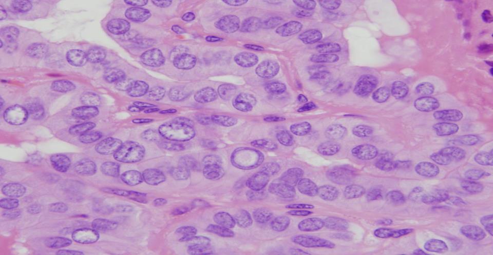 1.1.3 A pajzsmirigytumorok klinikai képe 1.1.3.1 Papillaris carcinoma A leggyakoribb rosszindulatú pajzsmirigydaganat a papillaris carcinoma, ez teszi ki az összes pajzsmirigytumor 60 80%-át.