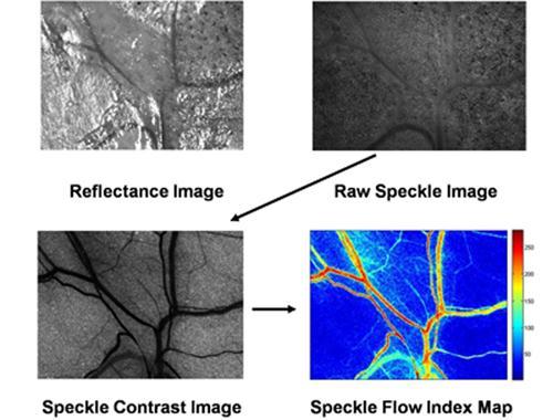 Nem invazív optikai módszerek: laser speckle A szórt koherens lézerfény interferenciája