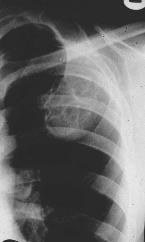Fibrosus dysplasia Ismeretlen eredetű Fibrosus szövet tölti ki a medullát 3-15 év