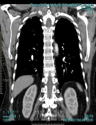 Hátsó mediastinum: paravertebralis Bochdalek hernia Születéskor