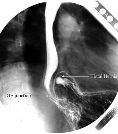 Rekesz Paraoesophageális hiatus hernia A cardia normális pozicióban van A gyomor egy