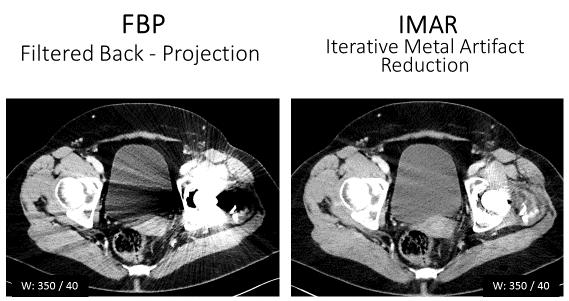 2. Ábra Bal csípőízületi protézis műtermékei Hagyományos (FBP) és IMAR rekonstrukcióval, Siemens Somatom Definition AS készülékkel, imar program alkalmazásával (Medence modulálta KV100, ref.