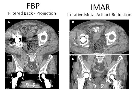 Ábra Mindkét csípő ízületben protézis A és C hagyományos (filtered back-projection=fbp) kép rekonstrukcióval, B és D iteratív metal artefact reduction = IMAR programmal.