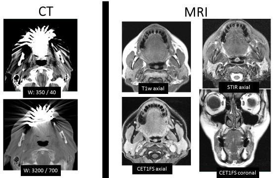 4. Ábra A szájüreg, mesopharynx szintjéről készült CT és MR képek. A két vizsgálat ugyanazon betegnél, változatlan státus mellett, néhány nap különbséggel történt.