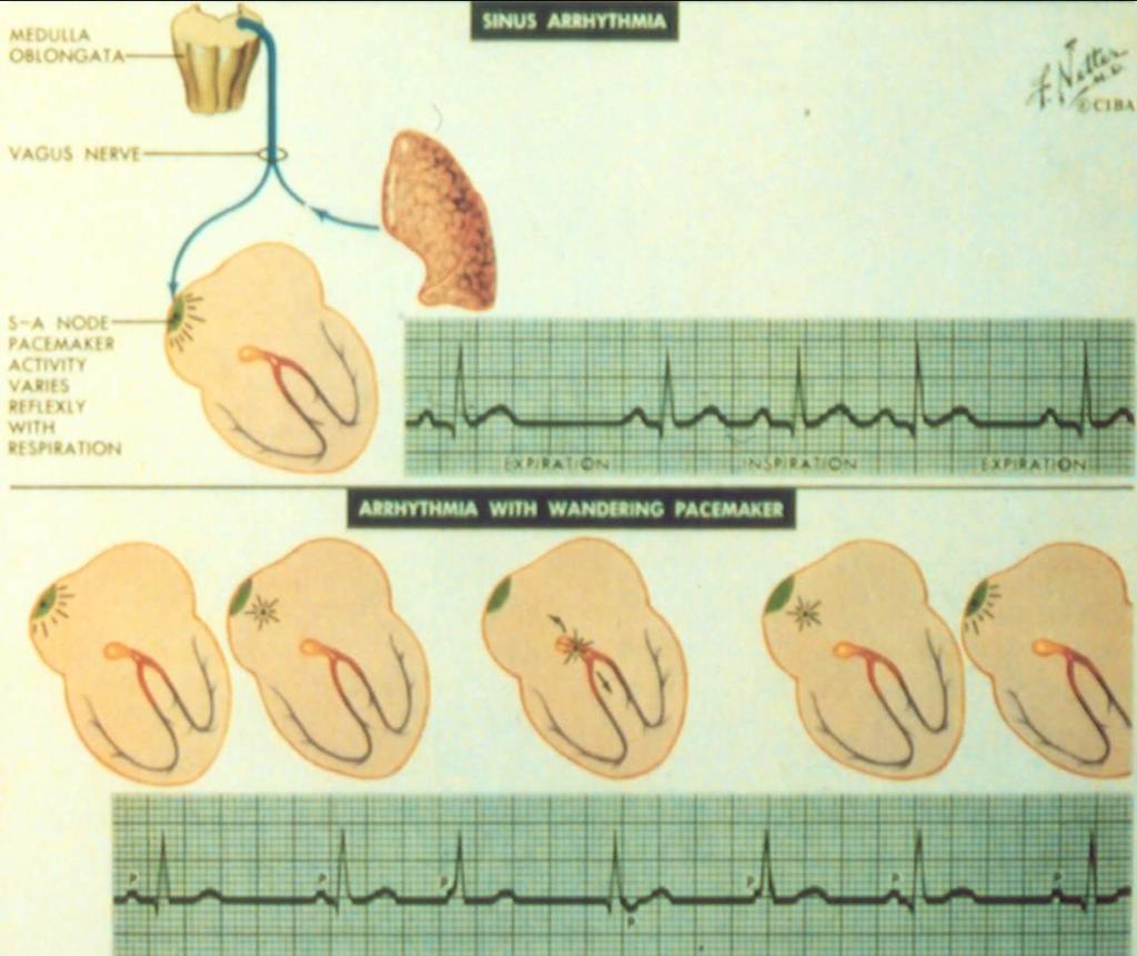 Sinus arrhythmia