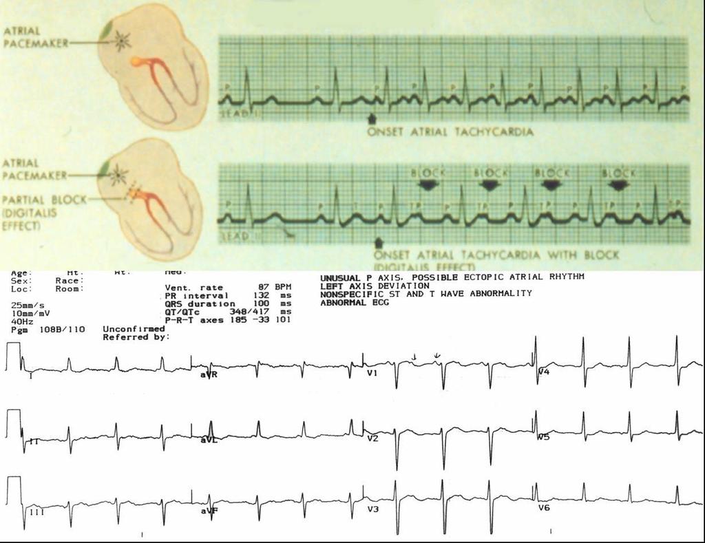 Pitvari tachycardia Kezelés: - Kezelése általában nem egyszerű. - Paroxysmalis esetben elsősorban elektromos cardioversio.