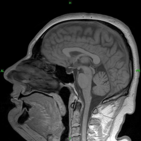 Parkinson-plus syndroma: MSA -