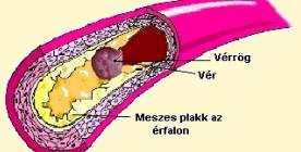 Triglicerid csökkentés 1/ életmód változtatás 2,30-4,50 mmol/, > 4,5mmol/l gyógyszer > 11,30mmol/l a zsírbevitel Kevesebb mint a napi összkalória 10% 2/ Vércukor normalizálás 3/