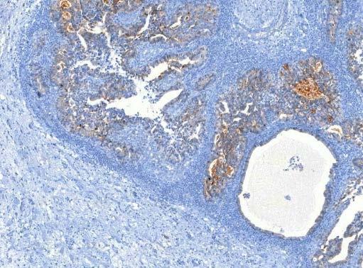 2 MTT Hírmondó PD-1- és PD-L1-expresszió vizsgálata a klinikai gyakorlatban Tüdőrákban az új fejlesztésű szerek közül legígéretesebbnek az immunellenőrzési pont gátlók (immune checkpoint inhibitors)