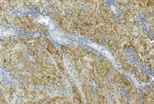 Az eddigi molekuláris célzott terápiákkal ellentétben a betegszelekció módszere még nem kidolgozott, habár egyes vizsgálatok a daganatsejtek PD-L1 immunhisztokémiai pozitivitásának prediktív értékét