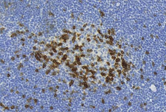 fázisú vizsgálatba korábban platinabázisú kemoterápiával kezelt, 122 nem kissejtes tüdőrákos (NSCLC) beteget vontak be.