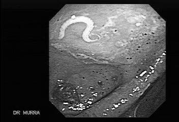 Ha megy és ha nem megy Hasmenés (diarrhea): híg, gyakori széklet (vizes,véres,erjedéses,rothadásos) Székrekedés (obstipatio): sűrű, ritka széklet ( besül ) Ileus: Az ileus elnevezés valójában egy