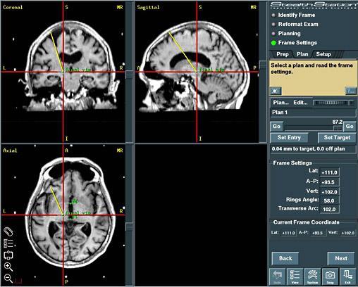 Stereoractic frame Neuronavigational system Identifying the target Neuroimaging Microelectrode