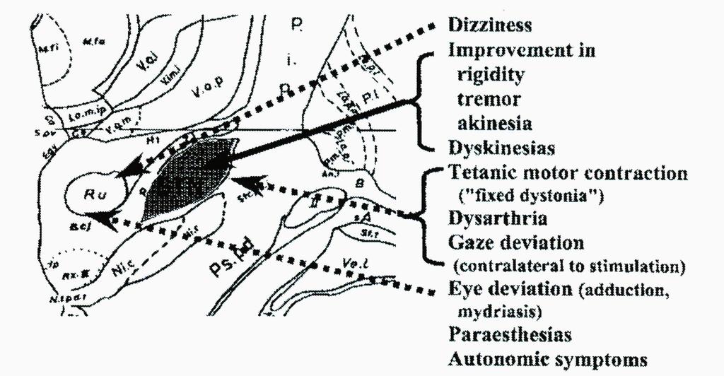 Intraoperative stimulation