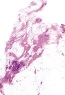 Direkt nagyított mammogramm: nyúlványos szélsô csillag árnyék polimorf mikrocalcifikátummal.
