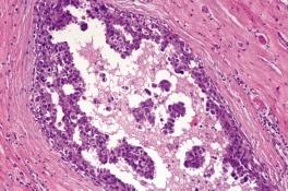 ytológia D Nagy csoportokban közepes méretû ductalis jellegû daganatsejtek.