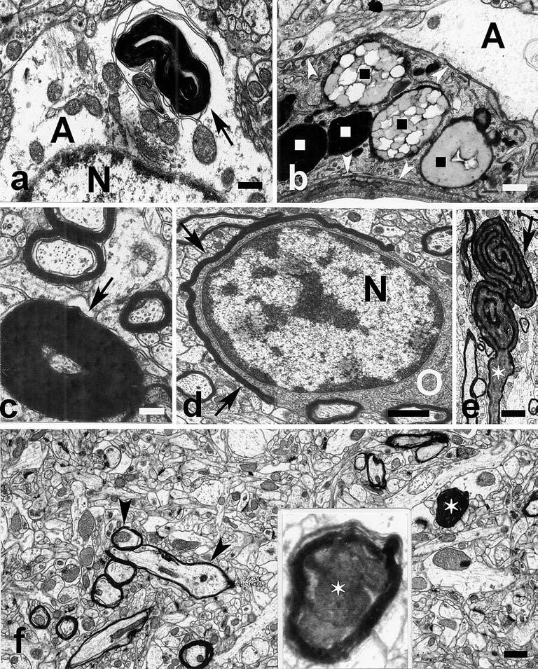 234 Fig. 4 Electron-microscopic pictures in layer IV or V of the neocortex in rats sacrificed 1 month (a e) or 6 months (f) after the production of a 0.75- mm-deep momentary calvaria depression.