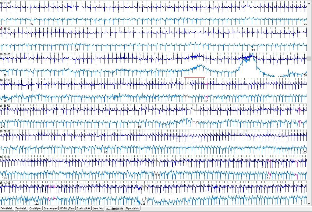 2. Frekvenciakiugrás: Ez sinus tachycardia: -