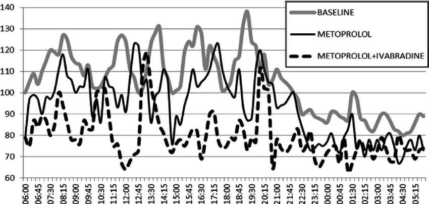 IV. Példa Inadekvát sinus tachycardiás beteg