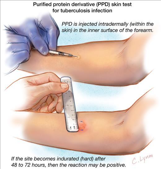Tuberculin Skin Test A tuberculin skin test (also called a Mantoux tuberculin test) is done to see if you have ever been exposed to tuberculosis (TB).