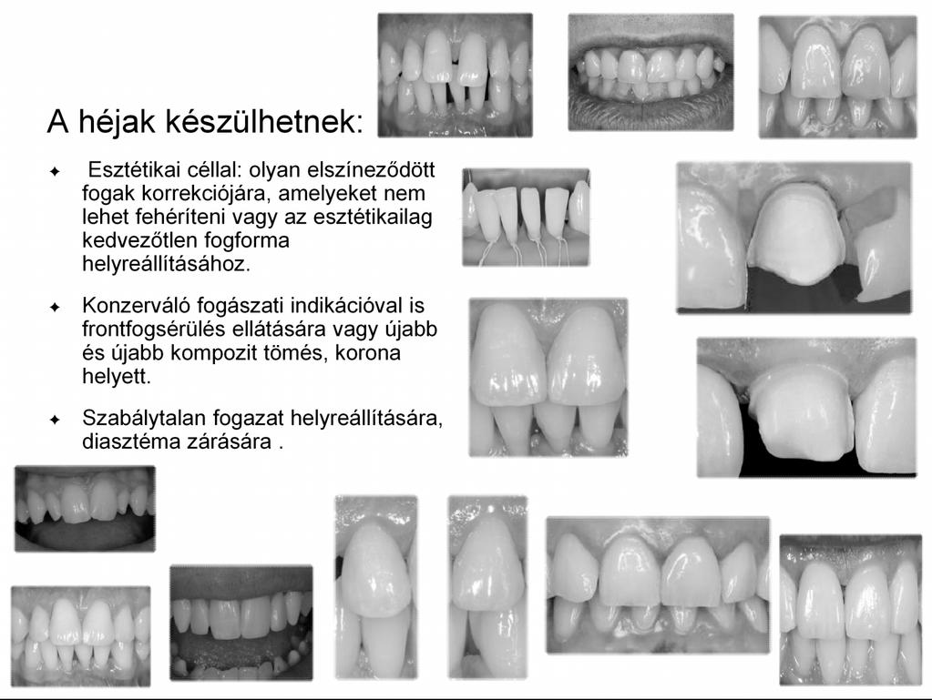 A héjak készülhetnek: Esztétikai céllal: olyan elszíneződött fogak korrekciójára, amelyeket nem lehet fehéríteni vagy az esztétikailag kedvezőtlen fogforma helyreállításához.