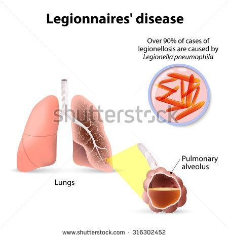 Legionellózis legionárius betegség: fő tünete a tüdőgyulladás, amely magas lázzal és változatos tünetekkel (hányás, hasmenés, fejfájás, idegrendszeri tünetek) társulva gyakran életveszélyes állapotot